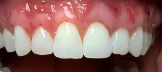 Connective Tissue Graft After