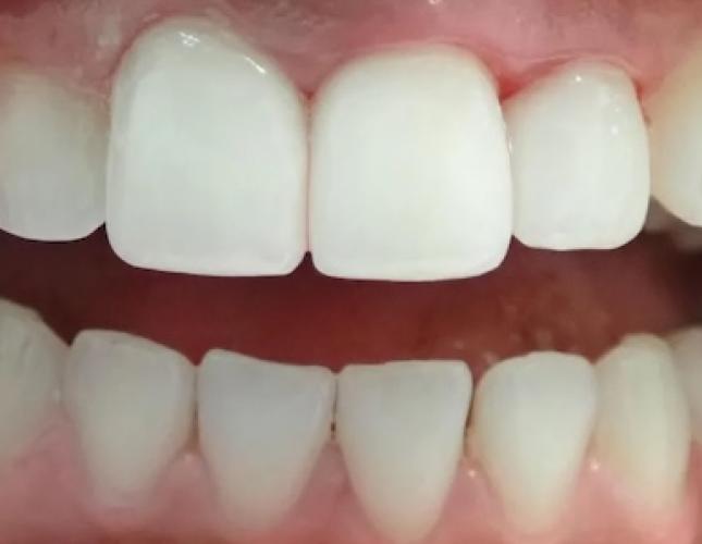 Ceramic Crowns 1 after