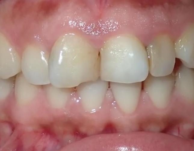 Ceramic Crowns 1 before
