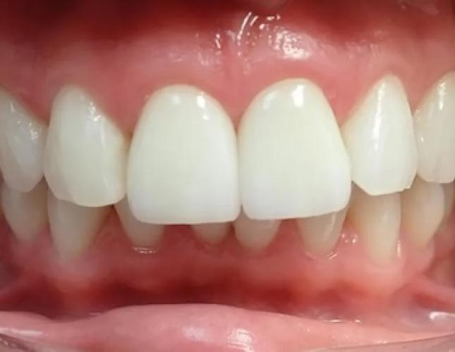 Ceramic Crowns 2 after