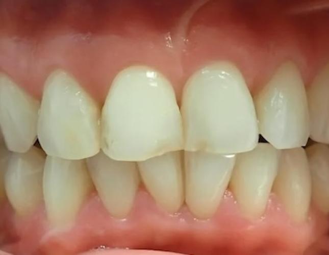 Ceramic Crowns 2 before