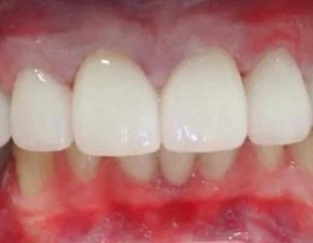 Ceramic Crowns 3 after