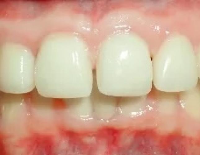Ceramic Crowns 3 before