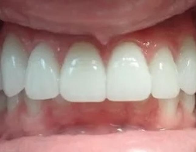 Digital Smile Design 1 after