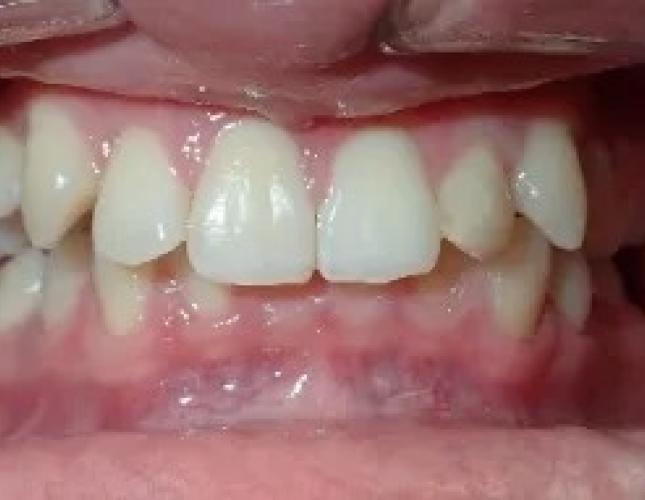 Digital Smile Design 1 before