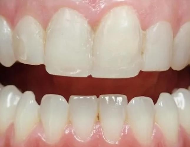 Digital Smile Design 2 before
