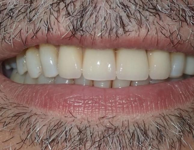 Dental Implants 1 after