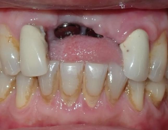 Dental Implants 1 before