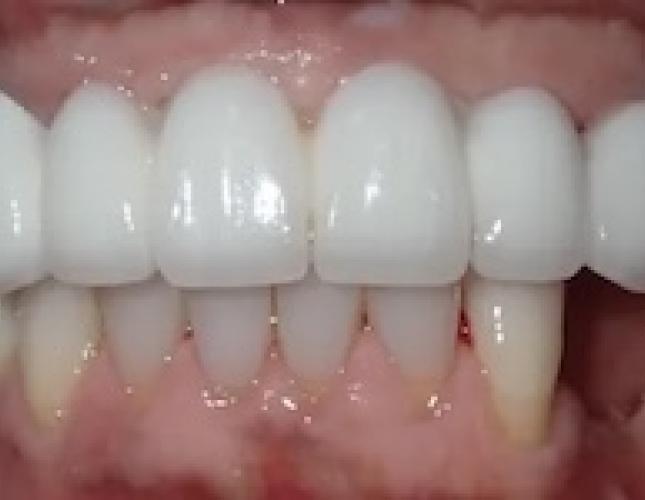 Dental Implants 2 after