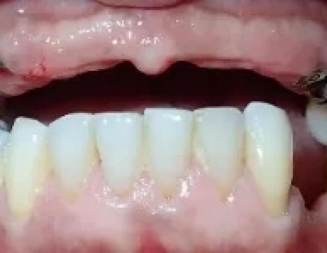 Dental Implants 2 before