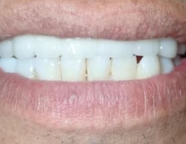 Dental Implants 3 after