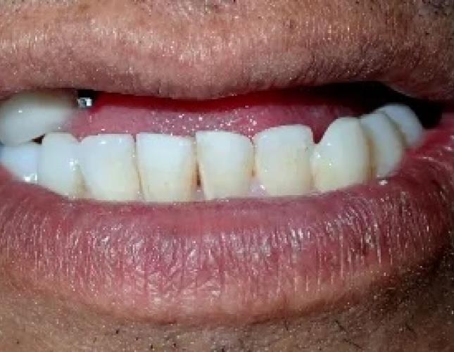 Dental Implants 3 before