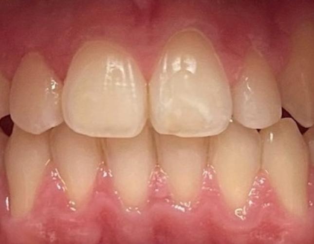 Invisalign 1 after