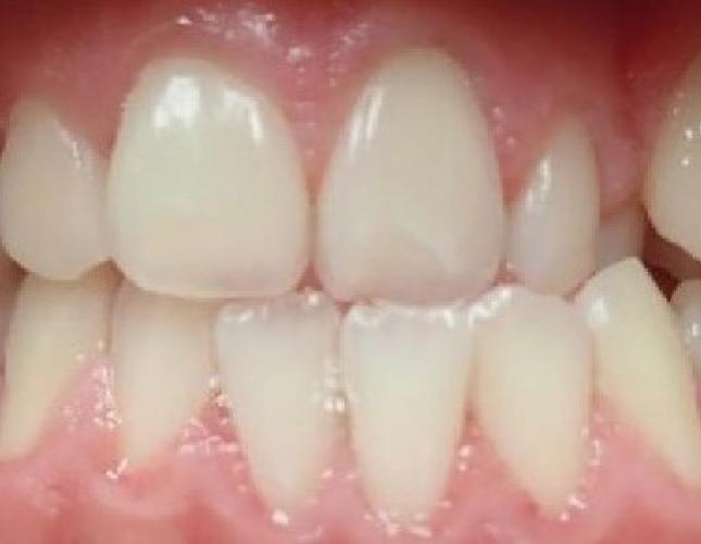 Invisalign 1 before