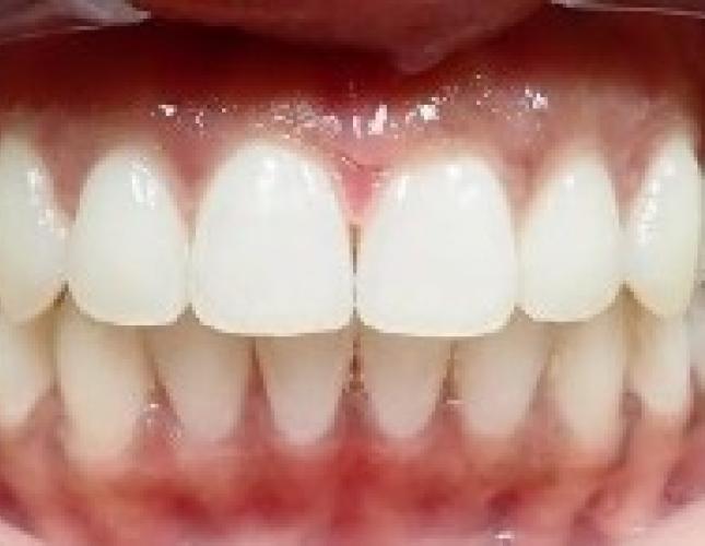 Invisalign 2 after