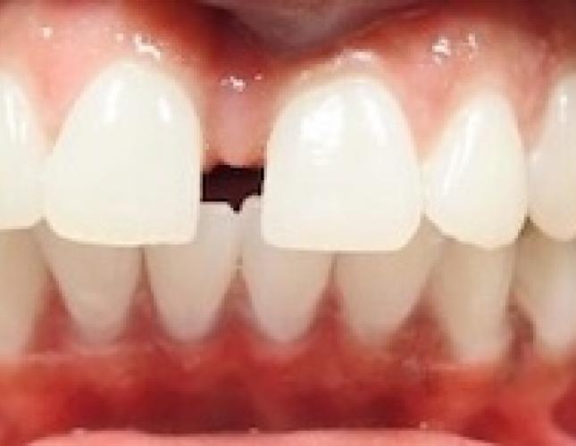 Invisalign 2 before