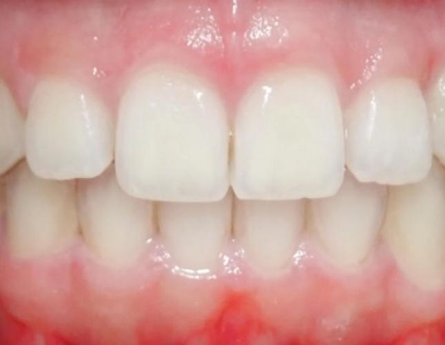 Invisalign 3 after