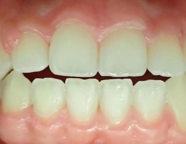 Invisalign 3 before