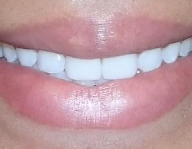 Invisalign and Laminates after