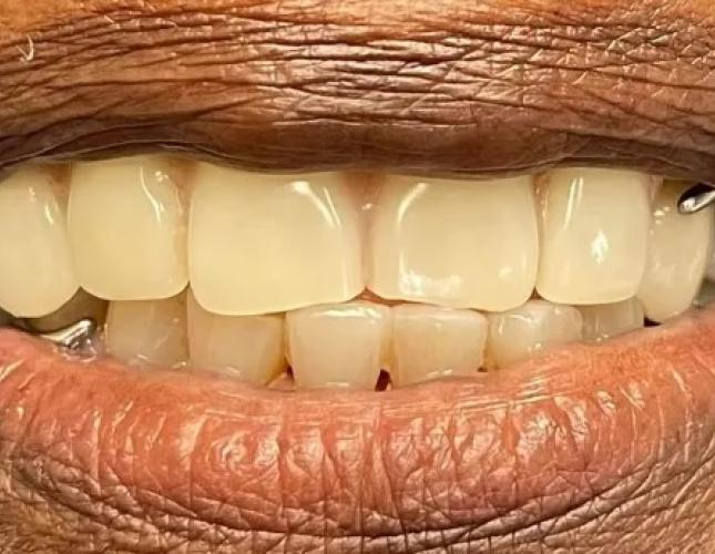 Partial Dentures 1 after
