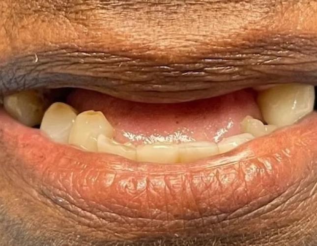 Partial Dentures 1 before