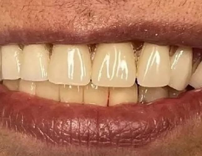 Partial Dentures 2 after