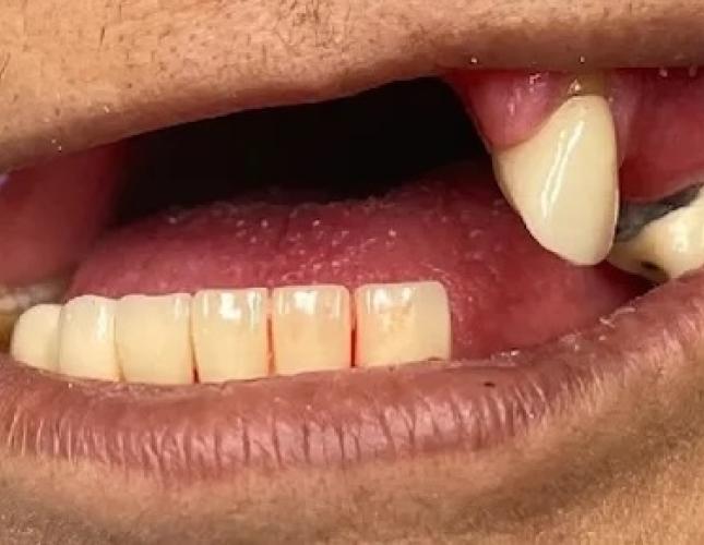 Partial Dentures 2 before