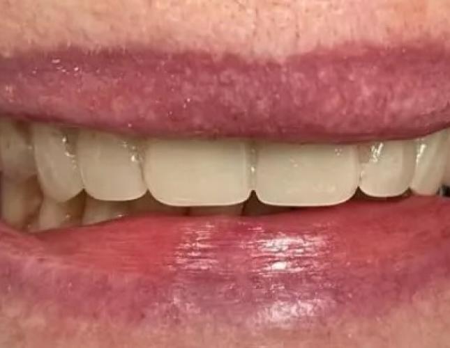 Partial Dentures 3 after
