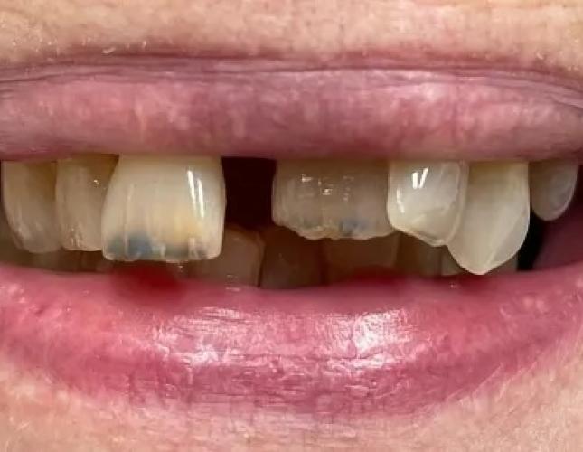 Partial Dentures 3 before
