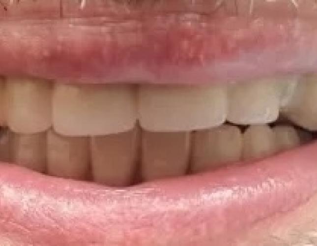 Partial Dentures 4 after