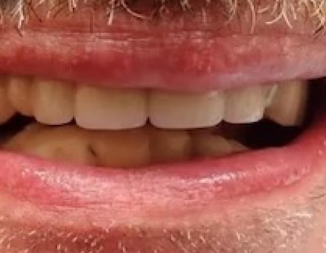 Partial Dentures 4 before