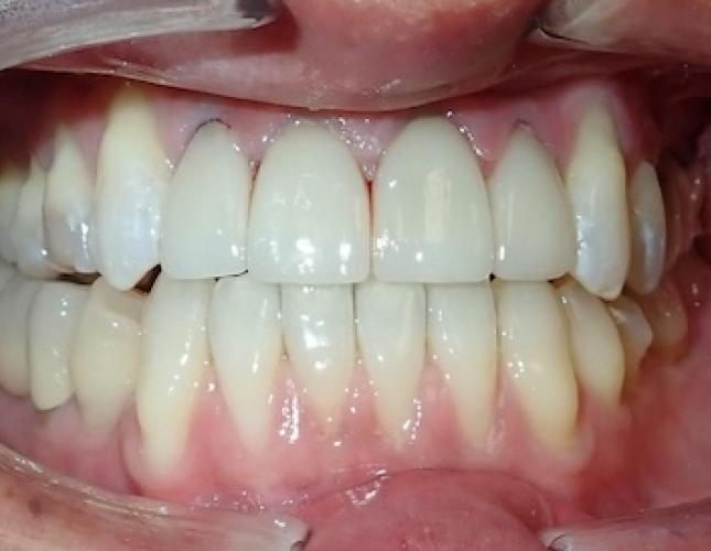 Smile Makeover 1 after