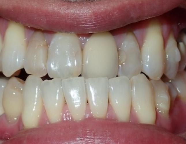 Smile Makeover 1 before
