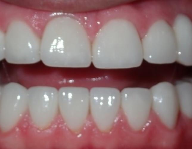 Smile Makeover 2 after