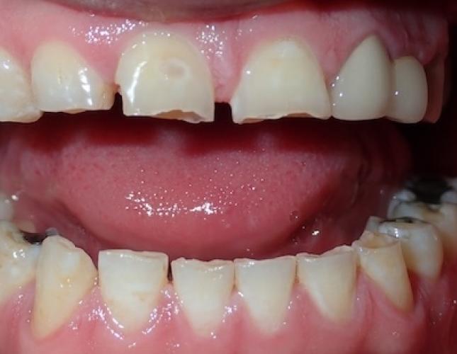 Smile Makeover 2 before