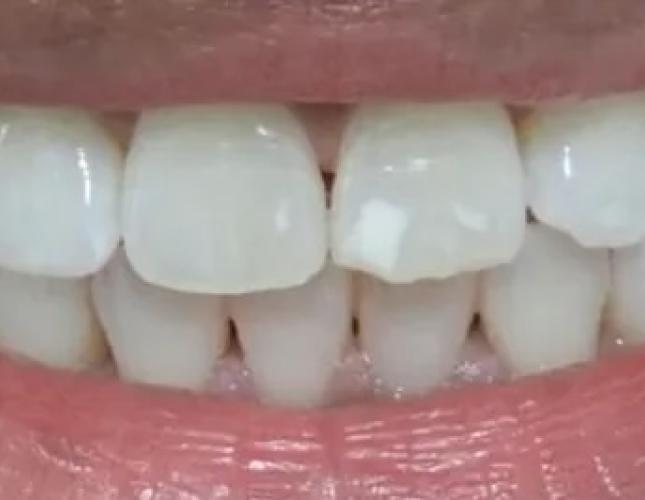 Zoom Whitening 1 after