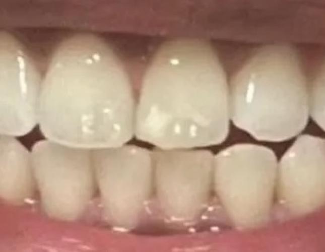 Zoom Whitening 1 before