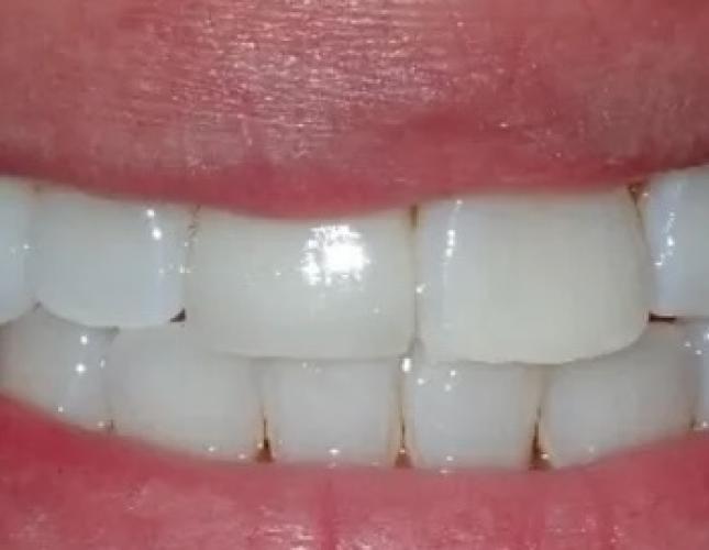 Zoom Whitening 2 after