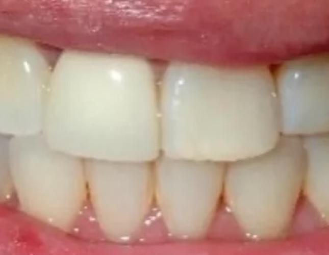 Zoom Whitening 2 before