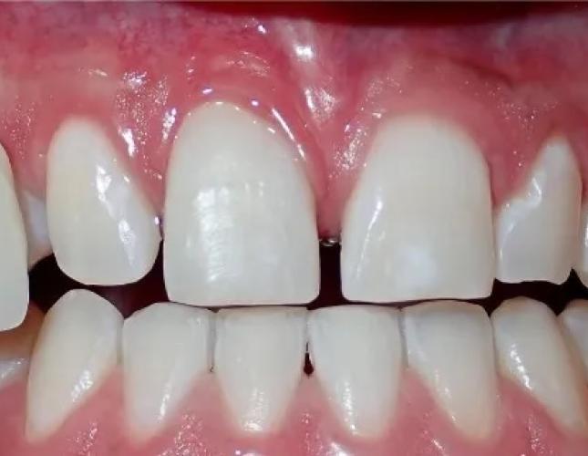 Zoom Whitening 3 after