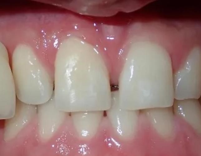 Zoom Whitening 3 before
