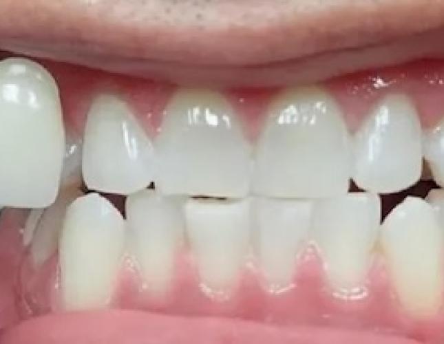 Zoom Whitening 4 after