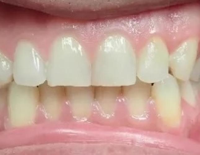 Zoom Whitening 4 before