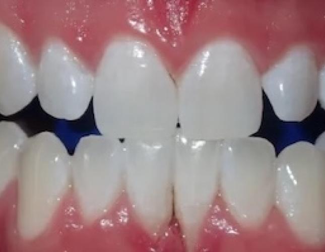 Zoom Whitening 5 after