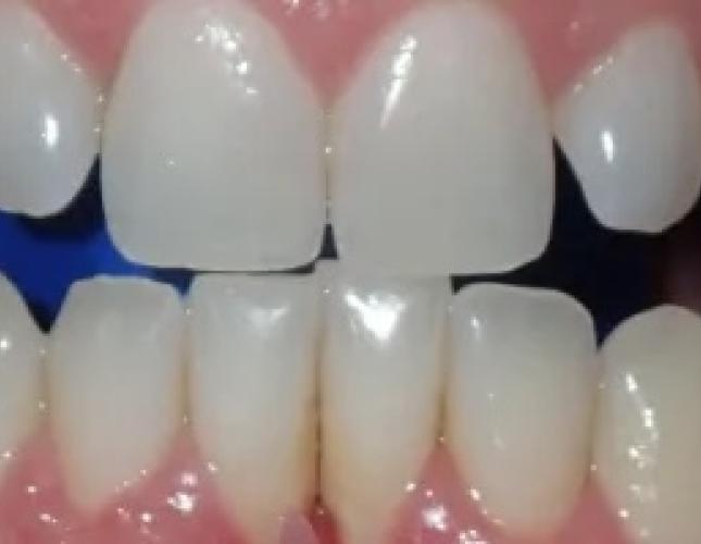 Zoom Whitening 5 before
