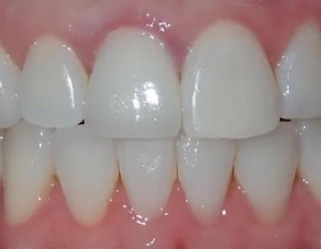Zoom Whitening 6 after