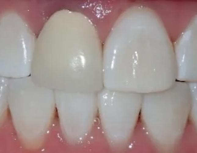 Zoom Whitening 6 before