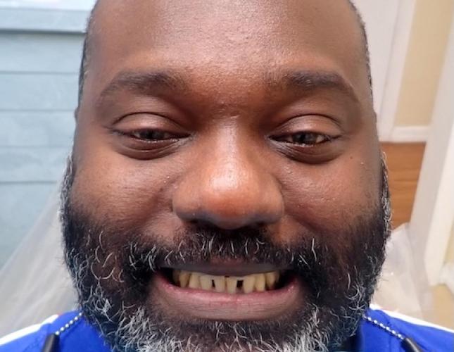 Clear Aligners full face before
