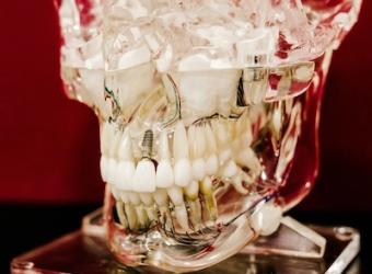 What Are the Most Common Types of Dental Implants?